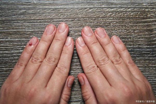 手指上的秘密诱惑:痣的神秘力量 手指上的秘密诱惑:痣的神秘力量