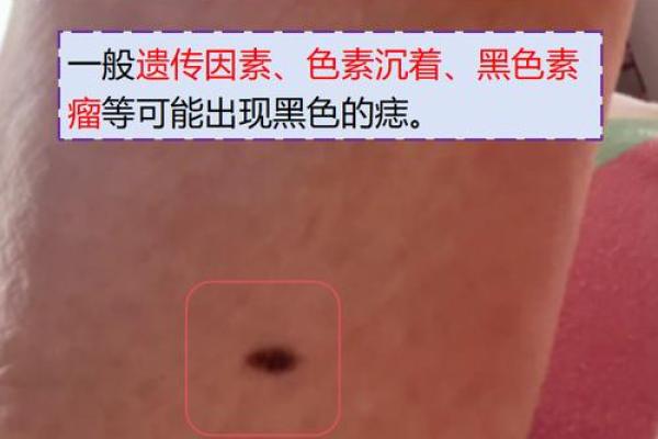 脚下痣的神秘解读:探寻你的个性与运势 脚下痣的神秘解读:探寻你的个性与运势