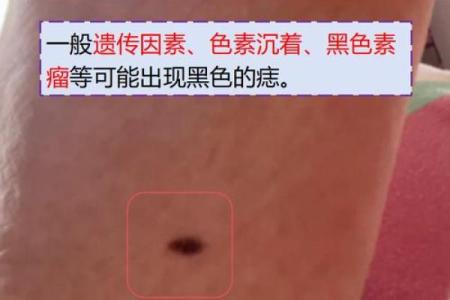脚下痣的神秘解读:探寻你的个性与运势