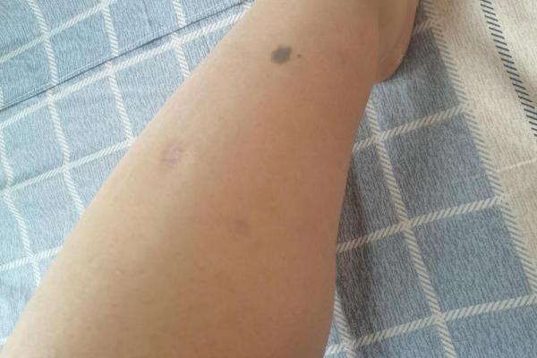 周易揭秘:腿上痣相全解,你的命运如何? 周易揭秘:腿上痣相全解,你的命运如何?