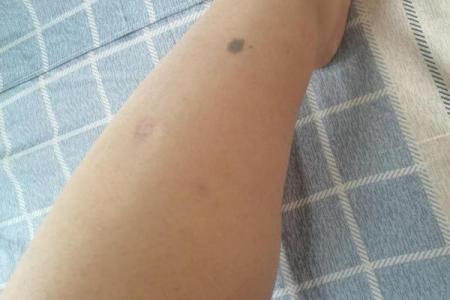 周易揭秘：腿上痣相全解，你的命运如何？