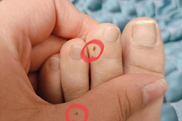 左手痣传奇：女性魅力的独特印记