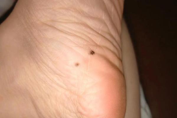 脚拇指痣魅力大揭秘:男人的独特魅力符号 脚拇指痣魅力大揭秘:男人的独特魅力符号