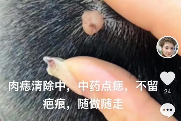 眉上肉痣:究竟隐藏着怎样的好运密码? 眉上肉痣:究竟隐藏着怎样的好运密码?