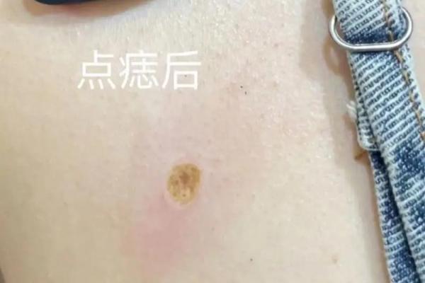 独特左颜，右痣点缀